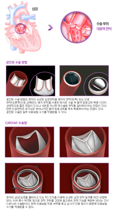 스타 흉부외과 의사 송명근 교수, 수술법 논란
